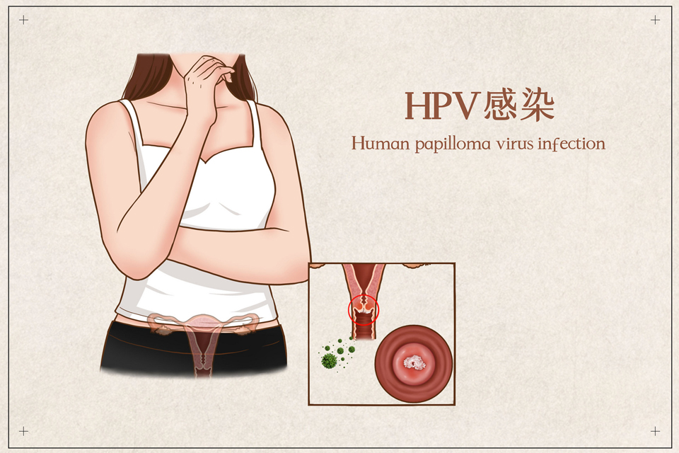 HPV阳性可以买保险